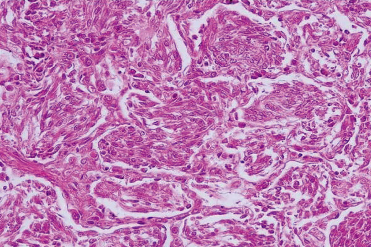Histopathological lesions of Hachiko’s lungs