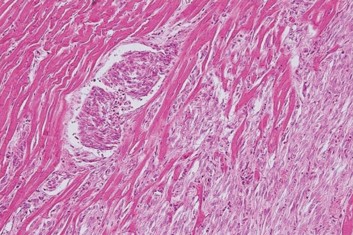 Histopathological lesions of Hachiko’s heart
